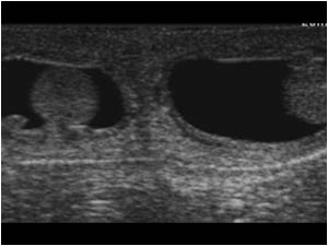 Another less dramatic cause of a swollen scrotum in a neonate is a communicating hydrocele.

This transverse image shows a normal homogeneous left and right testicle surrounded by fluid.