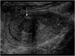 Transverse image of the same fibroid.