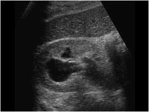 Transverse image of the right kidney with a dilatated collecting system.