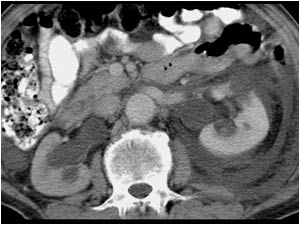 CT image at the level of the kidneys showing the right kidney with a dilatated collecting system and the left kidney with a perirenal effusion. The aorta at this level is normal.