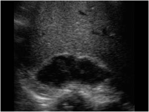  Longitudinal image of the smaller hypoechoic mass at the upperpole of the right kidney.