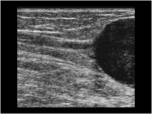Longitudinal image of the proximal end of the mass and the greater saphenous vein.