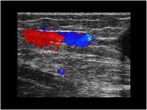 Longitudinal color doppler image of the proximal end of the mass and the greater saphenous vein. The vein is still patent.