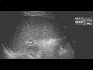 Longitudinal image of the spleen of the boy. It is too large for an exact measurement.