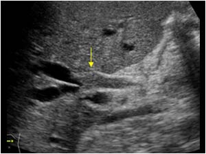 Transverse image of the upper abdomen with an intraductal structure in the bile ducts at the liver hilum
