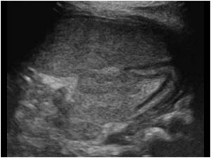 Transverse image of the normal left adrenal

Discussion
A non vascularized partly cystic mass in the adrenal in a neonate is suggestive for an adrenal hemorrhage. However in the case of an adrenal mass in a neonate a neuroblastoma should always be cons