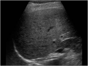 Diffuse small hypoechoic liver lesions
