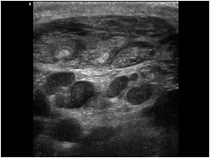 Inflamed sternocleidomastoid muscle transverse