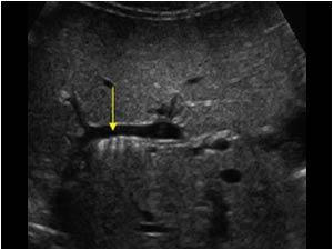 Bile duct stones without stones in the gallbladder