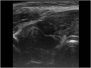 Diffuse infiltration of the right thyroid lobe transverse