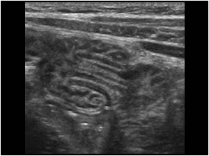 The same lesion in a longitudinal plane shows the typical bowel in bowel configuration of an intussusception.
