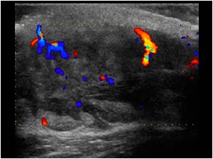 Metastasis 3 in the subcutaneous tissues color doppler
