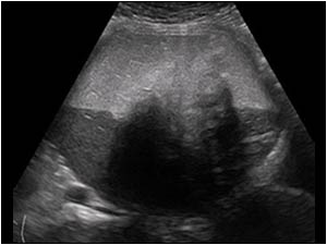 Case of the month January 2009: Dermoid cysts / cystic teratomas