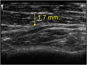 Swelling of the deep branch of the radial nerve longitudinal