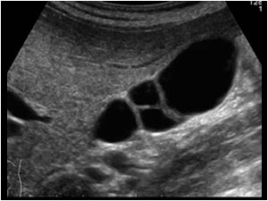 Longitudinal image of the gallbladder with thin septations across the gallbladder.