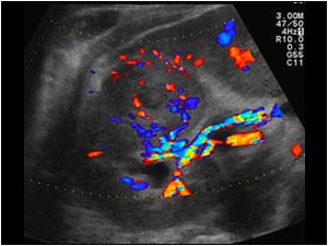 Transverse image of the right kidney with color Doppler. There is no flow in the central hypoechoic area.