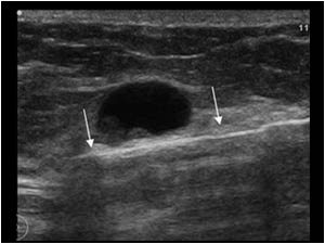 This image shows the vacuum biopsy needle direct underneath the abnormal cyst