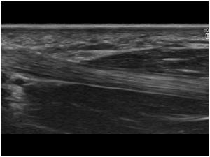 Volar aspect: Flexor pollicis longus tendon and thenar muscles longitudinal