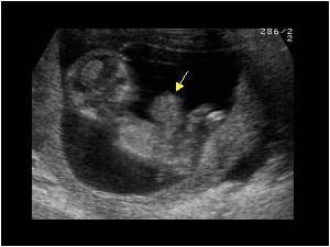 Gastroschisis seen in utero in a fetus with trisomie 13
