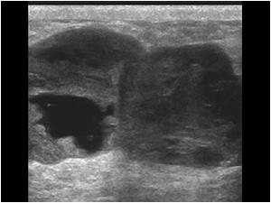 Hypoechoic mass in the left breast