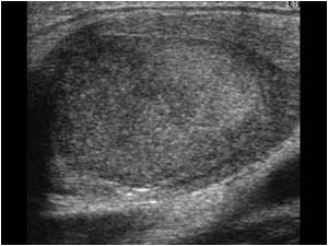 Brachial cleft cyst with internal echos longitudinal
