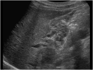 Longitudinal image of the empty gallbladder and abnormal structures. 