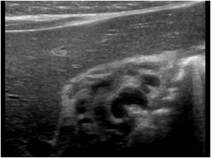 Detail image of the structures next to the gallbladder showing tortuous veins