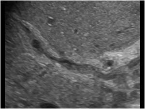 Dtail image of the bile ducts with tumor masses