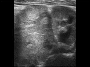 Transverse image of the extrarenal tumor impressing the kidney