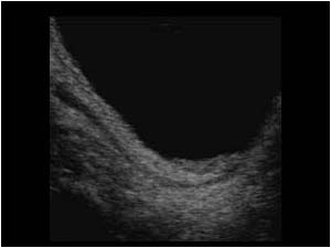 Hyperperistalsis in the distal ureter 2