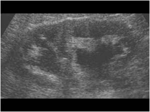 Obstruction in an incomplete duplex collecting system kidney longitudinal