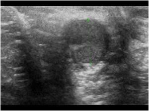 Transverse image of the same normal right testis. The left testis could not be found with ultrasound. Therefore we checked the kidneys