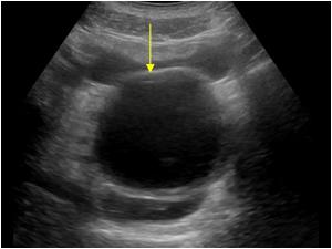 Transverse image of a cystic structure dorsal of the nearly empty bladder
