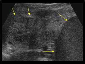 Uterine fibroids with endometrium impression and ovarian cyst posterior of the uterus