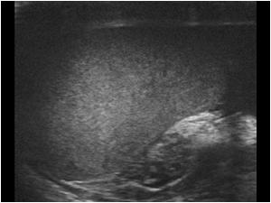 Longitudinal image with the knot dorsal of the testis