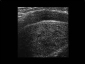 Nerve sheath tumor medial of the carotid artery longitudinal
