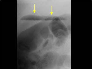 Air in the galbladder lumen and gallbladder wall