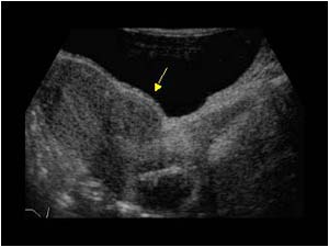 Leiomyoma (fibroid) in the anterior myometrium longitudinal
