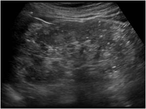 Longitudinal image of the left kidney