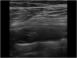 Detail image of the popliteal artery.
The stenosis is not caused by atherosclerotic changes
