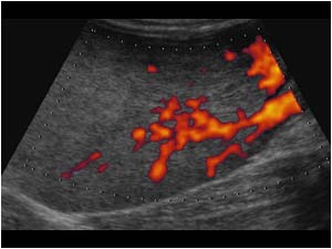 Massive enlargement of the left ovary