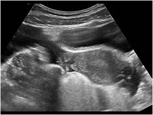 Transverse image of a normal uterus There is some free peritoneal fluid