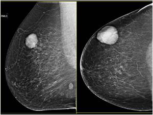 Mammography from 2012