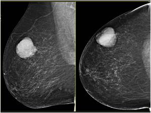 Mammography from 2013