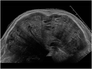 At the end of 2013 the lesion was so big thatwe had to use the extended field of view to get the mass in one image