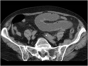 This is again a CT image taken at a lower level showing dilatated small bowel loops