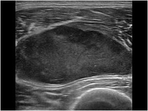 Oval well defined mass in the upper leg. Transverse view