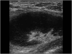 Enlarged lymphe node in the axilla