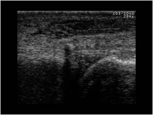 Tenosynovitis with synovial fluid caused by fragments of glas of which one is displaced to the level of the MCP joint