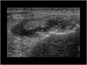 Transverse subluxation of the extensor carpi ulnaris tendon
